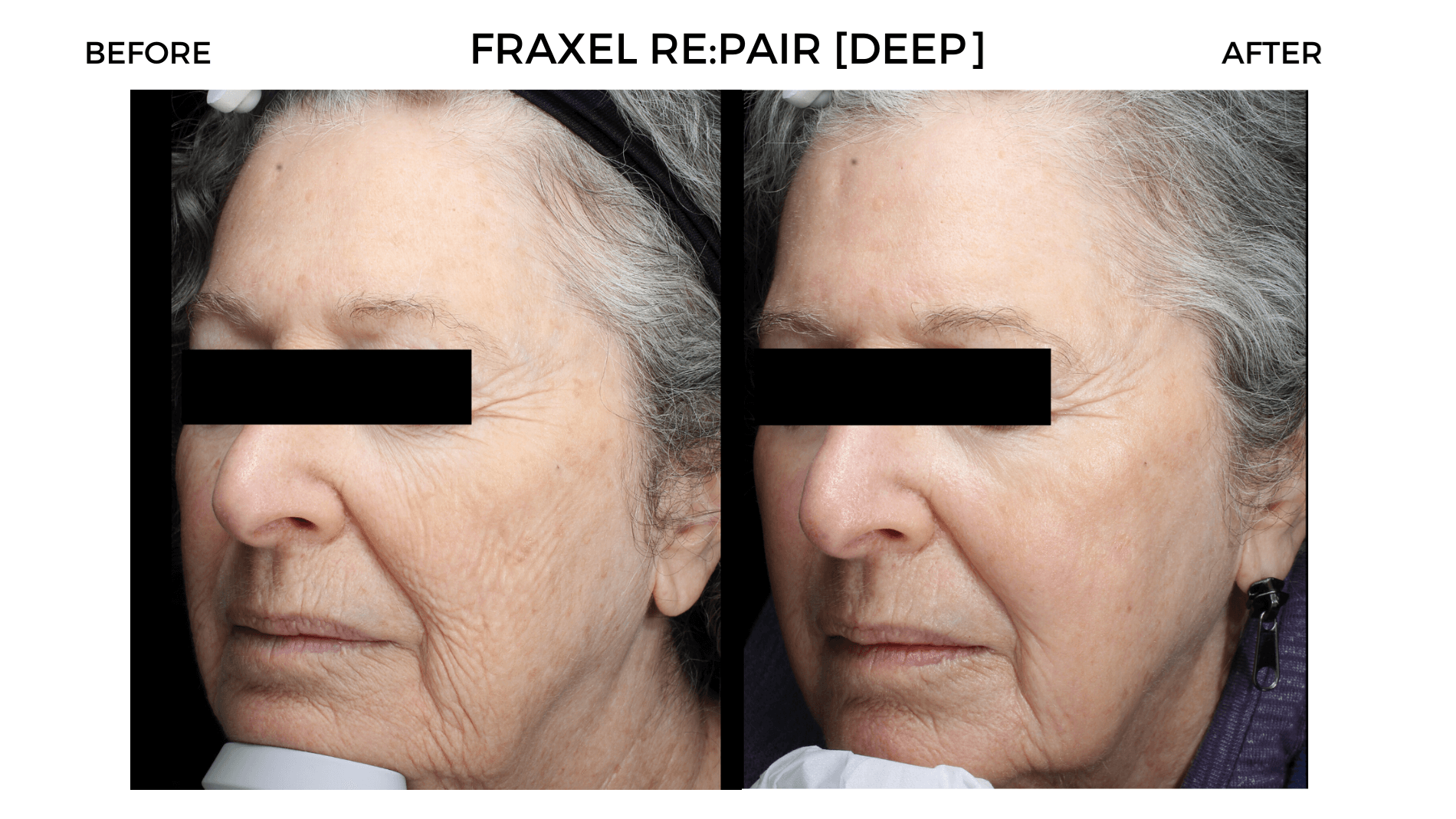 Fraxel Re:Pair Deep